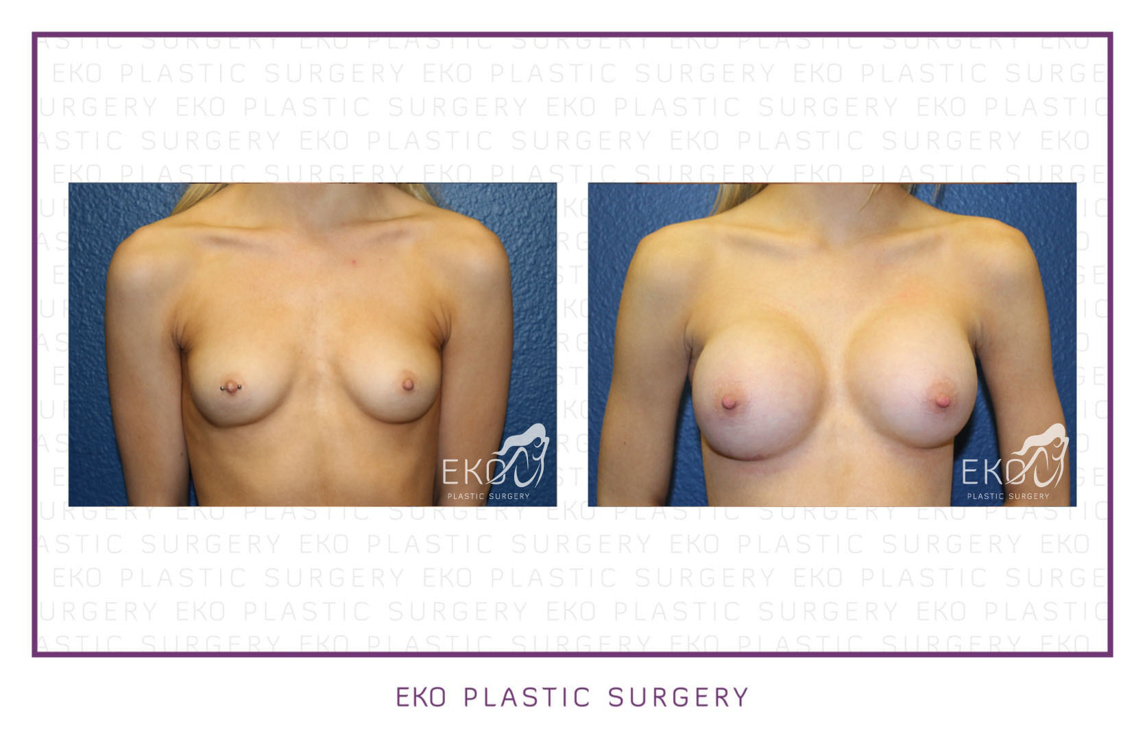 Breast Augmentation Before and After Photo by Dr. Eko of Eko Plastic Surgery in Palm Desert, CA