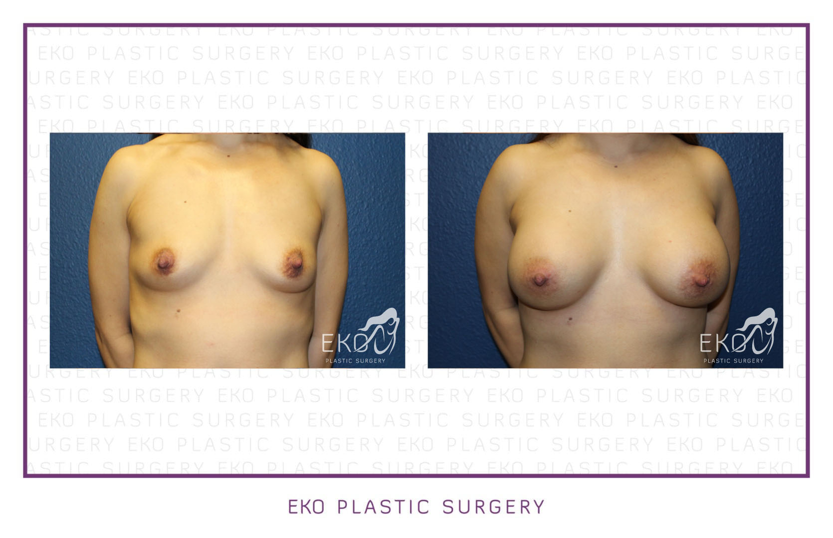 Breast Augmentation Before and After Photo by Dr. Eko of Eko Plastic Surgery in Palm Desert, CA