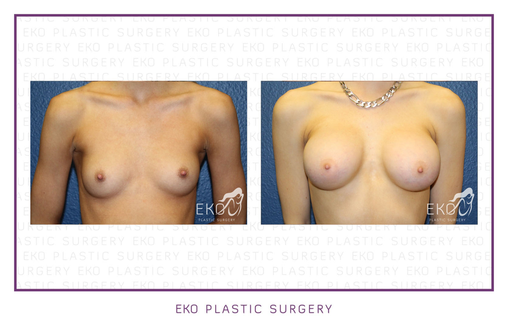 Breast Augmentation Before and After Photo by Dr. Eko of Eko Plastic Surgery in Palm Desert, CA